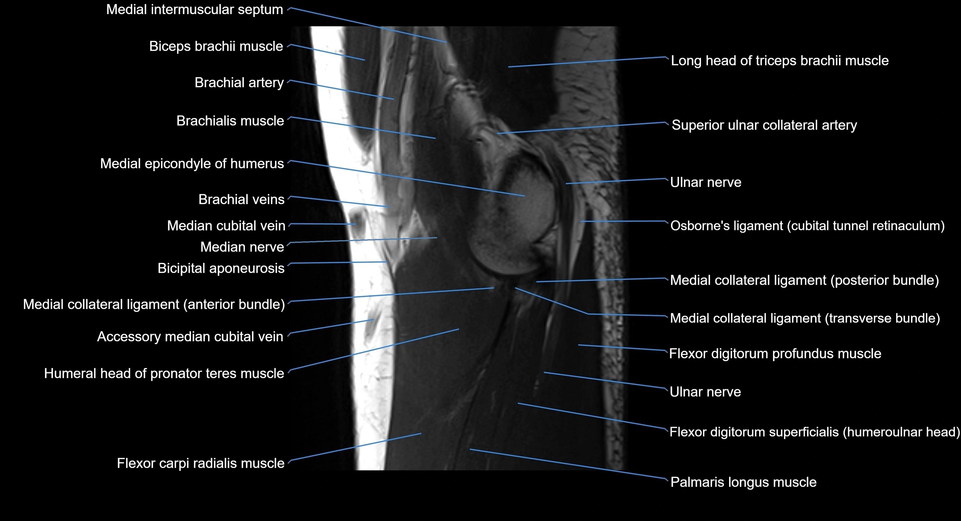 MRI elbow joint  sagittal cross sectional anatomy 3T  radiology  image-img-00001-00009.webp